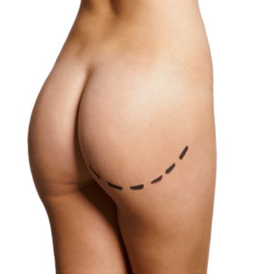 Buttock augmentation surgery in Medellín